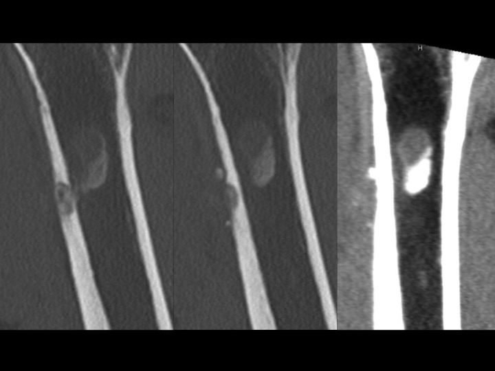 Figure 4 for case tendon of pectoralis major ( RID2007 )